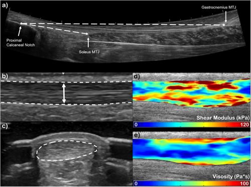 Brenna Pugliese (@brennapugliese) on Twitter photo Age is a known risk factor for Achilles tendon injury! This study in <a href="/JOrthopRes/">Journal of Orthopaedic Research®</a> showed age-related changes in healthy Achilles structure that may limit its capacity to store and transfer energy in older adults. Read it here 🔗 buff.ly/QwuxsOX #ORSSMC #TendonTuesday Age is a known risk factor for Achilles tendon injury! This study in <a href="/JOrthopRes/">Journal of Orthopaedic Research®</a> showed age-related changes in healthy Achilles structure that may limit its capacity to store and transfer energy in older adults. Read it here 🔗 buff.ly/QwuxsOX #ORSSMC #TendonTuesday