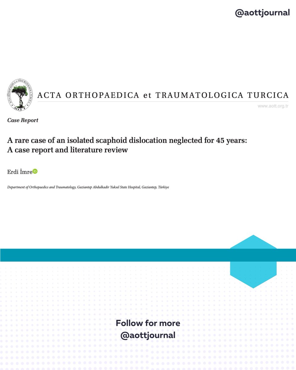 A neglected wrist injury left untreated for 45 years—this case presents the longest-reported delay in isolated scaphoid dislocation. Despite advanced arthritis and limited motion, radiocarpal fusion achieved pain relief and improved function.
#scaphoid #dislocation #writs #hand