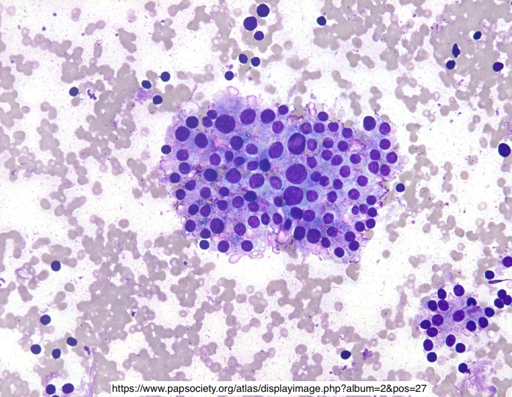 Path4People's tweet photo. 40 y/o F w β¬οΈ T4 and T3 β¬οΈ TSH and TRH
π§ͺ Found to have Thyroid stimulating antibodies
What are the name of these cells β¬οΈ π₯΅
#pathx #endocrine #medstudent #pathtwitter #fammed #internalmedicine https://t.co/gl0eno060l
