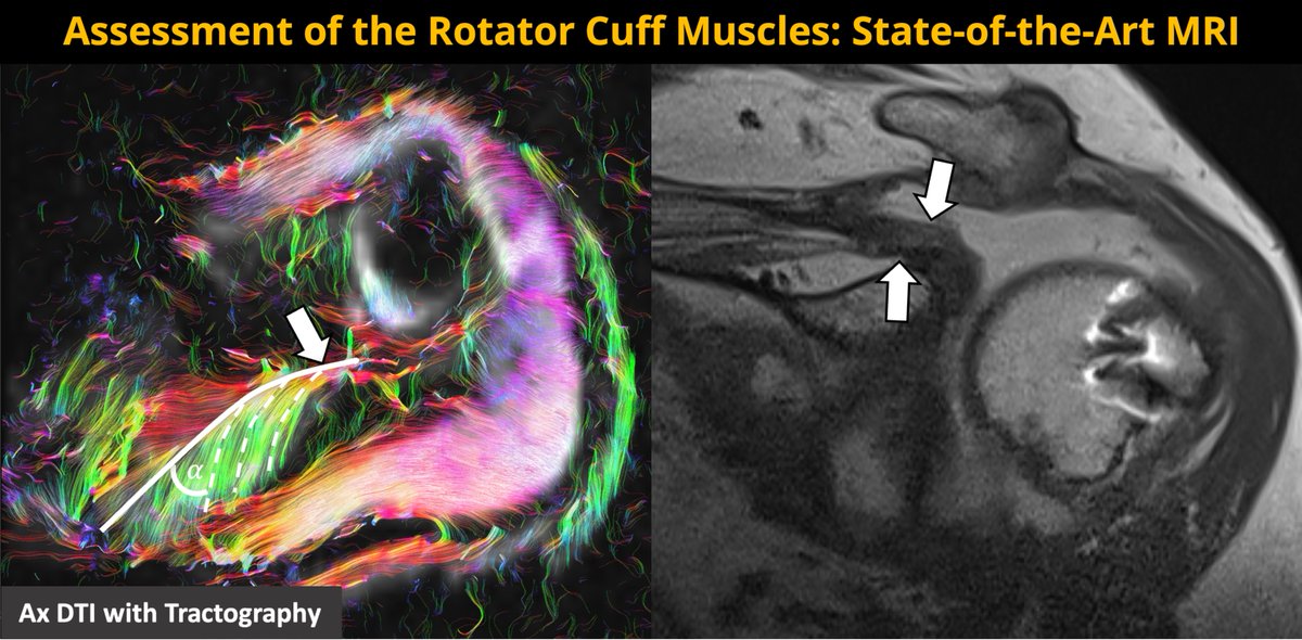 Georg Feuerriegel (@feuerriegelg) on Twitter photo Do you know how the #RCmuscle changes after tendon tear and how it is assessed on MRI?
👉Read our recent review in <a href="/radiology_rsna/">Radiology</a> :
doi.org/10.1148/radiol…
<a href="/SutterBalgrist/">Reto Sutter</a> <a href="/derbalgrist/">Balgrist University Hospital</a> <a href="/BalgristCampus/">Balgrist Campus</a> #RadInTraining <a href="/RITEditor/">Rad In Training Editor</a> Do you know how the #RCmuscle changes after tendon tear and how it is assessed on MRI?
👉Read our recent review in <a href="/radiology_rsna/">Radiology</a> :
doi.org/10.1148/radiol…
<a href="/SutterBalgrist/">Reto Sutter</a> <a href="/derbalgrist/">Balgrist University Hospital</a> <a href="/BalgristCampus/">Balgrist Campus</a> #RadInTraining <a href="/RITEditor/">Rad In Training Editor</a>