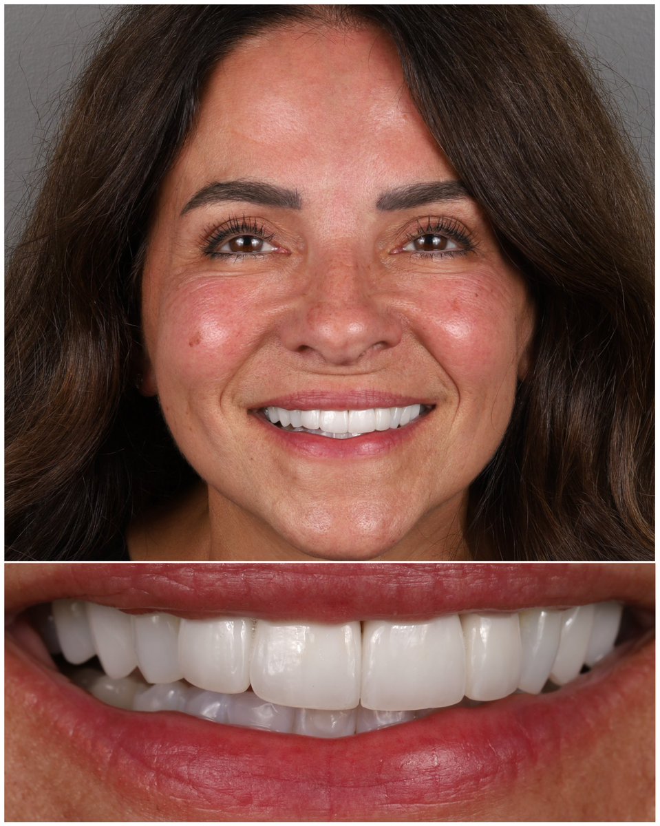 Swipe to see BEFORE ➡️
Patient’s goals: Patient really didn’t like her old veneers and wanted something more natural and not so big. 
What did we do? 10 upper porcelain Harmony veneers
Time it takes: 2-3 appointments Cost: Get a FREE personalized virtual consult and cost estimate