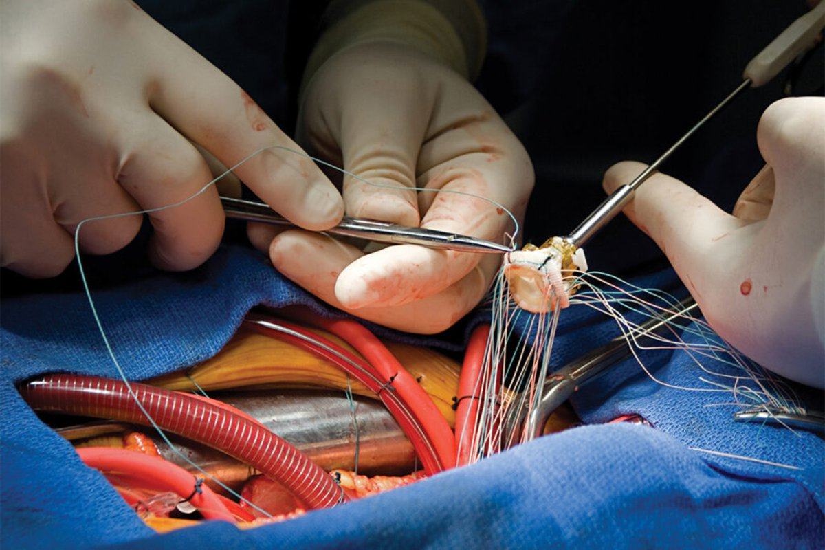 vincenz48713226's tweet image. When managing complex thoracic aortic disease, early intervention can save lives. Surgeons perform delicate procedures that aim to preserve heart function and prevent complications. 🔪🫀 #AorticSurgery #ComplexConditions #HeartCare

linkedin.com/posts/orwa-fal…