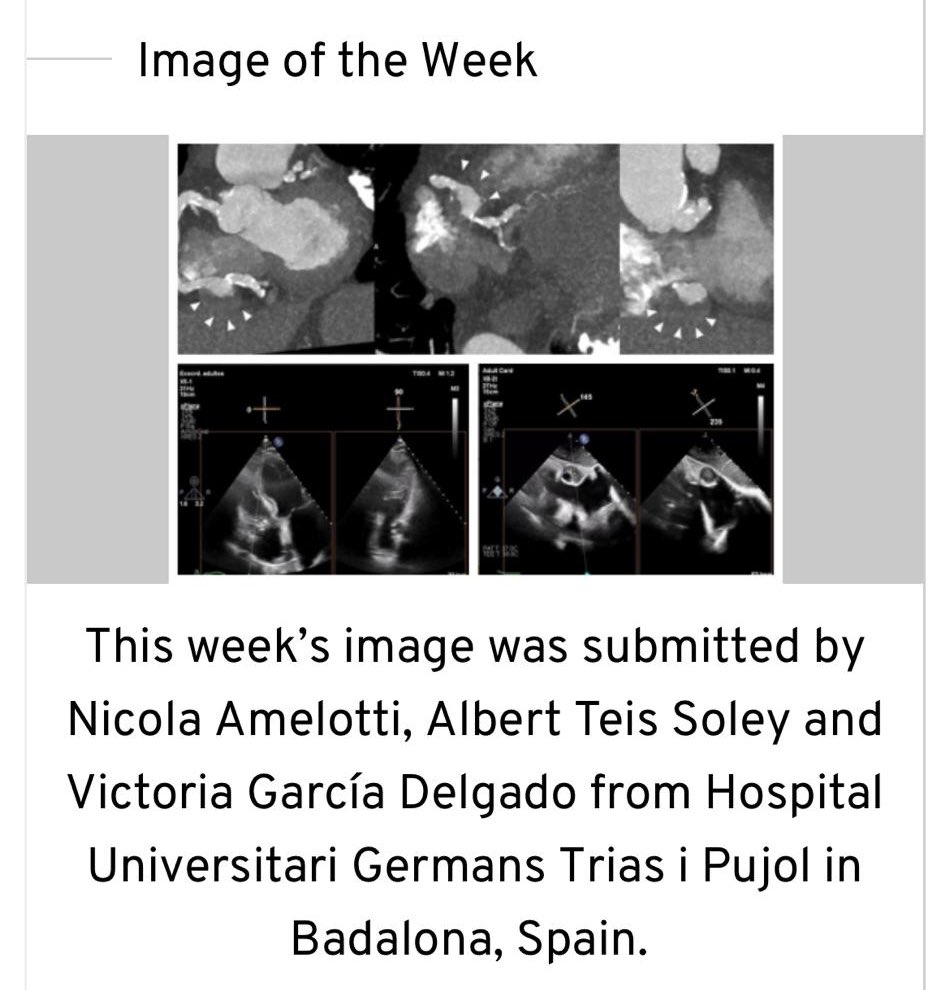Victoria Delgado (@vdelgadogarcia) on Twitter photo Today at The Image of the Week <a href="/iCorGTrias/">L'Institut del Cor del Germans Trias</a> brings you a challenge 👉escardio.org/Education/Imag… <a href="/Dr_ATeis/">Albert Teis, MD, PhD</a> <a href="/oriolrodriguez5/">Oriol Rodriguez</a> <a href="/Cardioresisgtip/">Resis Cardio CanRuti</a> <a href="/hgermanstrias/">Hosp. Germans Trias</a> <a href="/GTRecerca/">IGTP</a> <a href="/Heart_SCCT/">Heart_SCCT</a> <a href="/gpontone1/">Gianluca Pontone</a> <a href="/EACVIPresident/">EACVI President</a> <a href="/catcardio/">Societat Catalana de Cardiologia</a> <a href="/escardio/">European Society of Cardiology</a> <a href="/EFerrerSistach/">Elena Ferrer Sistach</a> <a href="/victoria_vilata/">Victoria Vilalta</a> <a href="/Xavi_Carrillo7/">Xavier Carrillo</a> Today at The Image of the Week <a href="/iCorGTrias/">L'Institut del Cor del Germans Trias</a> brings you a challenge 👉escardio.org/Education/Imag… <a href="/Dr_ATeis/">Albert Teis, MD, PhD</a> <a href="/oriolrodriguez5/">Oriol Rodriguez</a> <a href="/Cardioresisgtip/">Resis Cardio CanRuti</a> <a href="/hgermanstrias/">Hosp. Germans Trias</a> <a href="/GTRecerca/">IGTP</a> <a href="/Heart_SCCT/">Heart_SCCT</a> <a href="/gpontone1/">Gianluca Pontone</a> <a href="/EACVIPresident/">EACVI President</a> <a href="/catcardio/">Societat Catalana de Cardiologia</a> <a href="/escardio/">European Society of Cardiology</a> <a href="/EFerrerSistach/">Elena Ferrer Sistach</a> <a href="/victoria_vilata/">Victoria Vilalta</a> <a href="/Xavi_Carrillo7/">Xavier Carrillo</a>