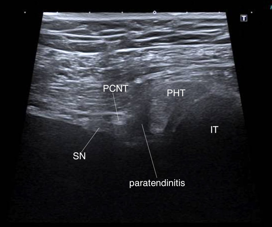 Consent ✅

Training for marathon - ramp in volume / distance

Initially inferior gluteal pain

Now evolved into more diffuse, neuropathic radiating 'ache' into posterior thigh to knee, but not below

See pain map

Worse with sitting, long leg stretch, inclines 

POCUS - proximal