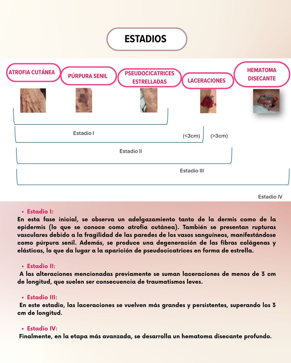 Sociedad Española de Heridas SEHER (@seheridas) on Twitter photo 🔴La dermatoporosis es mucho más que #piel frágil❤️🩹: es una consecuencia del envejecimiento cutáneo extremo que afecta cada vez a más personas mayores, aumentando el riesgo de #laceraciones, #hematomas y retrasos en la #cicatrización. ⚠️
🚀En <a href="/SEHERidas/">Sociedad Española de Heridas SEHER</a> trabajamos para dar 🔴La dermatoporosis es mucho más que #piel frágil❤️🩹: es una consecuencia del envejecimiento cutáneo extremo que afecta cada vez a más personas mayores, aumentando el riesgo de #laceraciones, #hematomas y retrasos en la #cicatrización. ⚠️
🚀En <a href="/SEHERidas/">Sociedad Española de Heridas SEHER</a> trabajamos para dar