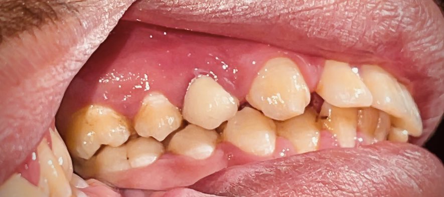 The last dance of 4th level 
Exam case"single PFM crown for left upper first premolar "