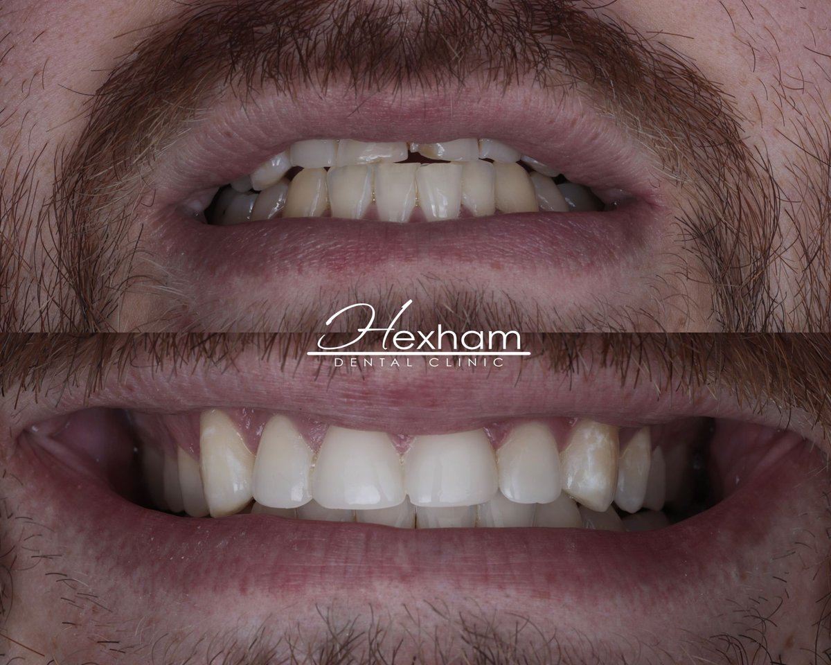 🦷✨ Invisalign = Healthier Teeth &amp; Gums! ✨🦷

Did you know Invisalign can do more than straighten your smile? It helps improve oral hygiene and protects your teeth from wear and tear!