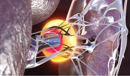 Cath Lab Digest (@cathlabdigest) on Twitter photo Use of the Paradise™ Ultrasound Renal Denervation (uRDN) System for Treatment of Uncontrolled Hypertension:
CMS Transitional Pass-Through Payment Effective January 1, 2025
CLD talks with <a href="/DrAmirKaki/">Amir Kaki, MD</a>
hubs.ly/Q03lfB7k0
#cardiotwitter <a href="/ReCorMedical/">Recor Medical</a> Use of the Paradise™ Ultrasound Renal Denervation (uRDN) System for Treatment of Uncontrolled Hypertension:
CMS Transitional Pass-Through Payment Effective January 1, 2025
CLD talks with <a href="/DrAmirKaki/">Amir Kaki, MD</a>
hubs.ly/Q03lfB7k0
#cardiotwitter <a href="/ReCorMedical/">Recor Medical</a>
