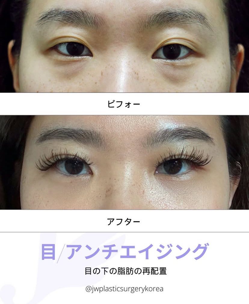JWSurgeryKorea's tweet photo. ジョンウォン整形外科で目の下の脂肪の再配置をおこなわれたお客様のビフォーアフターです🥰✨❤️

ご連絡はこちらまで💁‍♀️日本語🆗✨:
english@jwbeauty.net

👉もっと多くのレビューをチェックしてみてください: #jwkorea_review

➡️無料オンライン相談:

👉https://t.co/rms0eLwTSR

📧メール: english@jwbeauty.net

💚LINE: jwpsjp

💬WhatsApp:

010-7195-5114

010-6389-5114

010-4779-5116

010-5768-5114

#jwジョンウォン整形外科 #韓国整形外科 #整形外科 #韓国おすすめ #手術後 #二重整形　#埋没 #ビフォーアフター  #整形レポ #江南 #渡韓整形 #韓国好きな人と繋がりたい #Jwplasticsurgery #モデル募集 #無料
