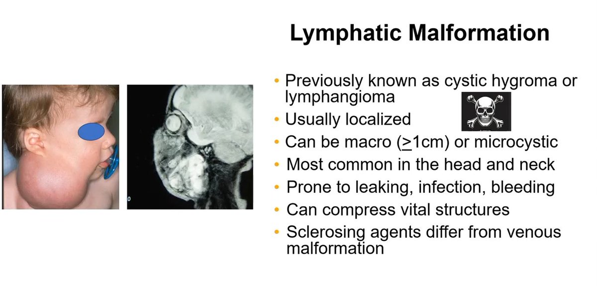 Lymphatic malformation (known previously as cystic hygroma or lymphangioma)
Macrocystic (&gt;= 1 cm) they can be treated with sclerosing agents
Microcystic can be treated with surgery or combination

Dr. Gupta #USCAP25 #pathology #PathX