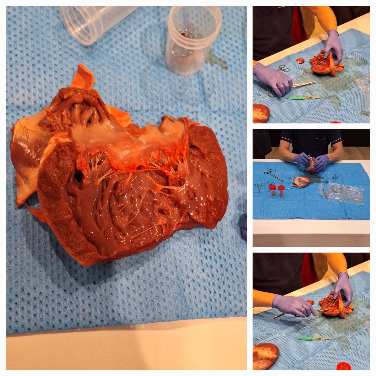 Ayer tuvo lugar la 2a Edición del curso de Enfermería en Procedimientos Intervencionistas de Cardiología Estructural (EPICE)
Aquí os dejamos un resumen del día de ayer!
#hemodinamica #estructural #aeec #epic #enfermería #cardio #formación #empoderamiento