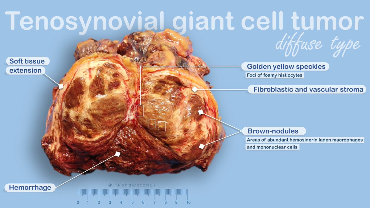 Wondweson64 Alemu (@_wondweson64) on Twitter photo GROSSnosis & Annotations | 👇
◆Site: 🦵Knee joint | 16x12cm
◆Diagnosis:🔬Tenosynovial giant cell tumor, diffuse type
<a href="/AceMyPath/">Ace My Path</a> #pathoutpic #pathx #BSTpath <a href="/Pathoutlines/">PathologyOutlines.com</a> #pathresidents #gross GROSSnosis & Annotations | 👇
◆Site: 🦵Knee joint | 16x12cm
◆Diagnosis:🔬Tenosynovial giant cell tumor, diffuse type
<a href="/AceMyPath/">Ace My Path</a> #pathoutpic #pathx #BSTpath <a href="/Pathoutlines/">PathologyOutlines.com</a> #pathresidents #gross