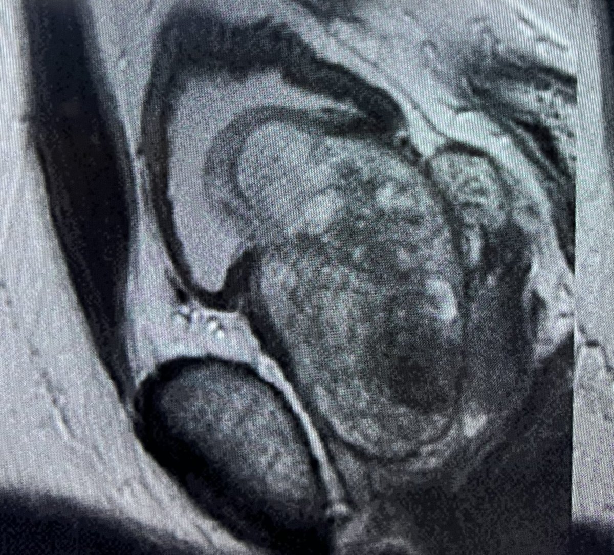 DR CARVAJAL (@romancarvajal) on Twitter photo I believe the term intravesical lobe should be reconsidered as lobe causing bladder compression. The image is quite illustrative—the prostate compresses the bladder externally, which becomes especially evident during a Retzius-sparing approach. #HoLEP, #RSRARP
<a href="/smumexico/">SMU México</a> I believe the term intravesical lobe should be reconsidered as lobe causing bladder compression. The image is quite illustrative—the prostate compresses the bladder externally, which becomes especially evident during a Retzius-sparing approach. #HoLEP, #RSRARP
<a href="/smumexico/">SMU México</a>