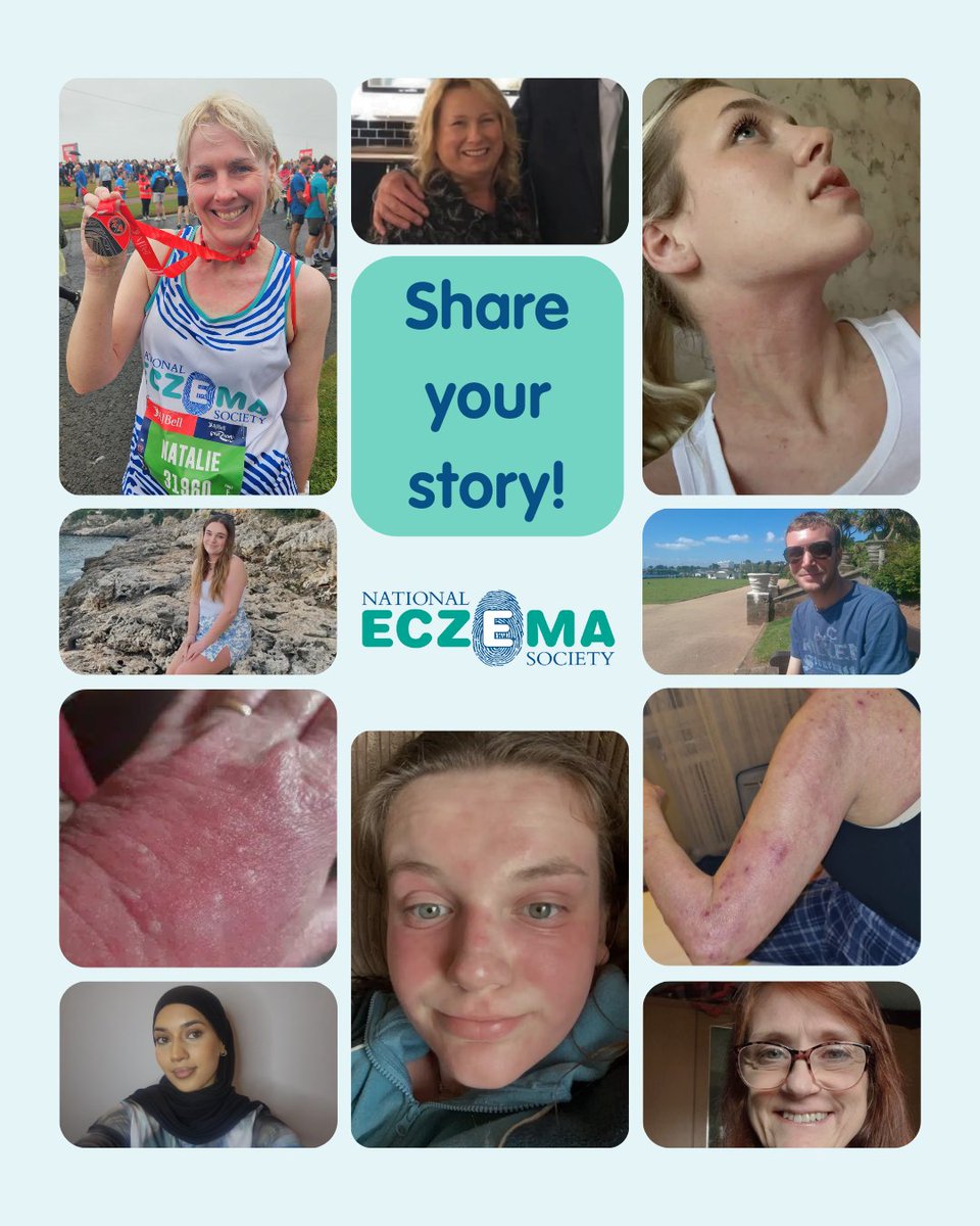 National Eczema Society (@eczemasociety) on Twitter photo 📢 We want to hear from you!
Sharing your experience of eczema, treatment, and how eczema impacts you could help someone else going through the same thing.
Together let’s raise awareness of eczema.
📨 Please email our team at press@eczema.org for more details or to share 📢 We want to hear from you!
Sharing your experience of eczema, treatment, and how eczema impacts you could help someone else going through the same thing.
Together let’s raise awareness of eczema.
📨 Please email our team at press@eczema.org for more details or to share