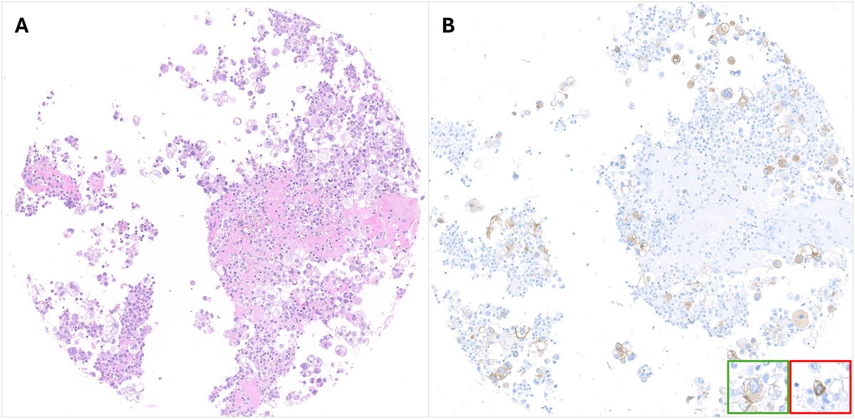 Cancer Cytopathology (@cancercytopath) on Twitter photo #OpenAccess | The SAMPLING project: A multi-institutional, international study demonstrates room for improvement in inter-pathologist agreement for PD-L1 evaluation on cytological samples
acsjournals.onlinelibrary.wiley.com/doi/full/10.10…
<a href="/elena_vigliar/">Elena Vigliar</a> <a href="/mtsiddi/">Momin Siddiqui</a> <a href="/Acanfora95/">Gennaro Acanfora, MD</a> <a href="/Sinchita_Roy/">Sinchita Roy MD PhD</a>
#CytoPath #OpenAccess | The SAMPLING project: A multi-institutional, international study demonstrates room for improvement in inter-pathologist agreement for PD-L1 evaluation on cytological samples
acsjournals.onlinelibrary.wiley.com/doi/full/10.10…
<a href="/elena_vigliar/">Elena Vigliar</a> <a href="/mtsiddi/">Momin Siddiqui</a> <a href="/Acanfora95/">Gennaro Acanfora, MD</a> <a href="/Sinchita_Roy/">Sinchita Roy MD PhD</a>
#CytoPath