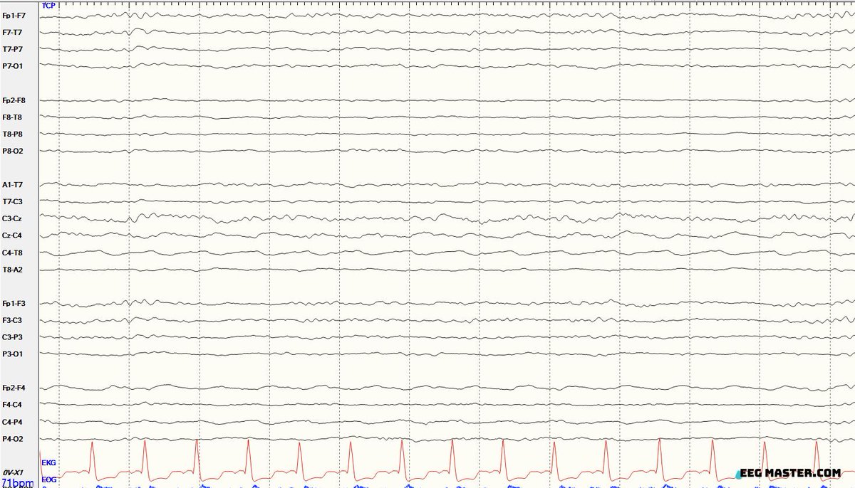 What is more likely to be the scenario associated with this finding on EEG? Click on the link to see options, submit the answer &amp; view the explanation. eegmaster.com/eegmaster/quiz…
