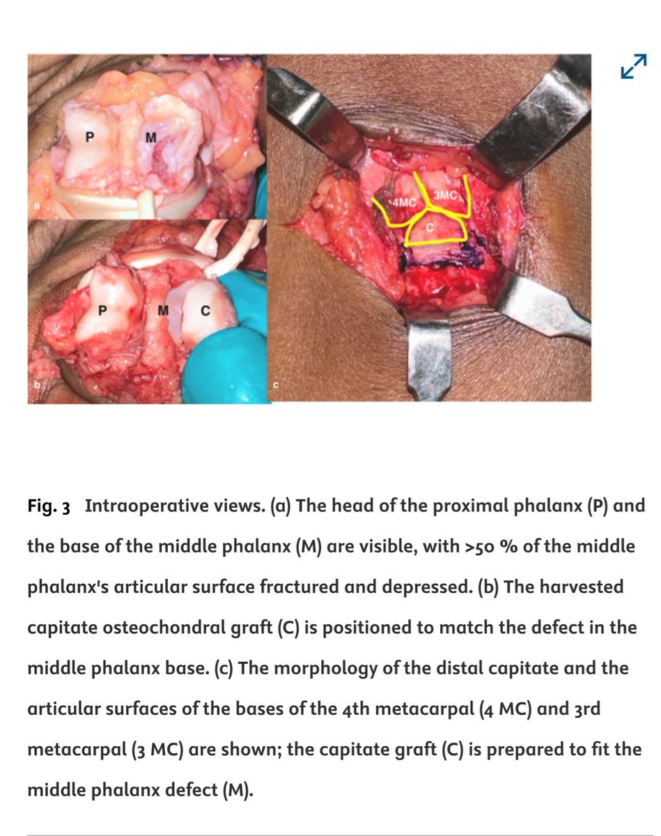 Terrence Jose Jerome, FRCS (@terrencejose) on Twitter photo Hemi-capitate arthroplasty for chronic unstable dorsal PIP fracture-dislocations. Significant ROM gain,high success (87% excellent), & quick return to activity.Full text: doi.org/10.1016/j.jcot… <a href="/JHandSurg/">J Hand Surg Am- ASSH</a> <a href="/prsjournal/">Plastic and Reconstructive Surgery</a> <a href="/PRSGlobalOpen/">PRS Global Open</a> <a href="/jbjs/">J Bone & Joint Surg</a> <a href="/BoneJointJ/">The Bone & Joint Journal</a> <a href="/JHSEur/">The Journal of Hand Surgery (European Volume)</a> <a href="/FESSHEurope/">FESSH</a> <a href="/AAOS1/">AAOS</a> Hemi-capitate arthroplasty for chronic unstable dorsal PIP fracture-dislocations. Significant ROM gain,high success (87% excellent), & quick return to activity.Full text: doi.org/10.1016/j.jcot… <a href="/JHandSurg/">J Hand Surg Am- ASSH</a> <a href="/prsjournal/">Plastic and Reconstructive Surgery</a> <a href="/PRSGlobalOpen/">PRS Global Open</a> <a href="/jbjs/">J Bone & Joint Surg</a> <a href="/BoneJointJ/">The Bone & Joint Journal</a> <a href="/JHSEur/">The Journal of Hand Surgery (European Volume)</a> <a href="/FESSHEurope/">FESSH</a> <a href="/AAOS1/">AAOS</a>