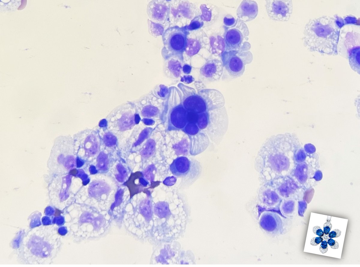 FridaRosenblum's tweet image. A beautiful cytopathology flower. Pleural fluid; metastatic carcinoma. #pathart