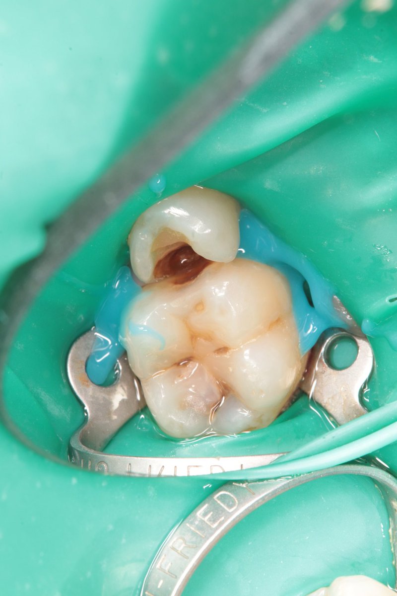 dentist_amar617's tweet image. حشوة قديمه سقطت من فترة  وتسوس عميق
تم ازالة التسوس القريب   من اللثة  وبناء حشوة
التسوس اثر على طرف السن  المجاور فلذلك تم ازالة التسوس وعمل حشوة له
#DME a d class II resto for lower 2nd premoalr and class II resto 1st molar back to back
Done with sno plow technique
#saveatooth