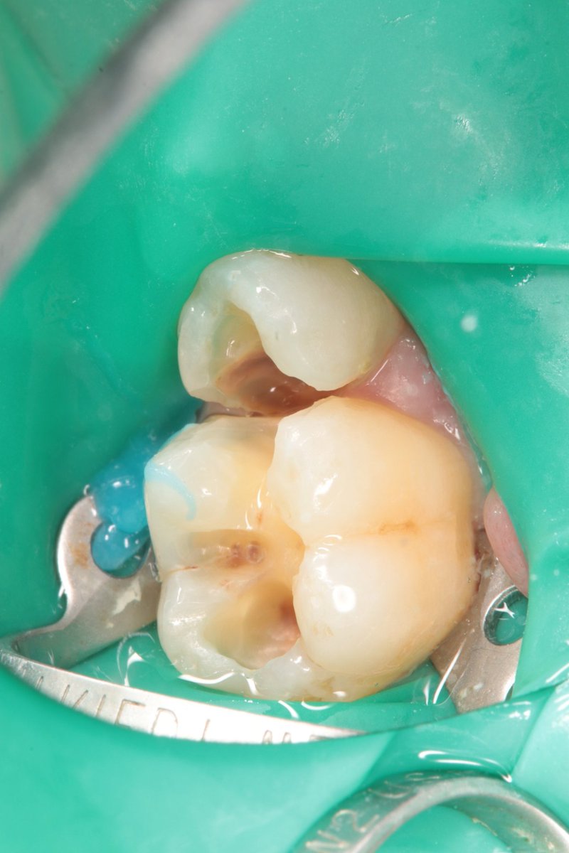 dentist_amar617's tweet image. حشوة قديمه سقطت من فترة  وتسوس عميق
تم ازالة التسوس القريب   من اللثة  وبناء حشوة
التسوس اثر على طرف السن  المجاور فلذلك تم ازالة التسوس وعمل حشوة له
#DME a d class II resto for lower 2nd premoalr and class II resto 1st molar back to back
Done with sno plow technique
#saveatooth