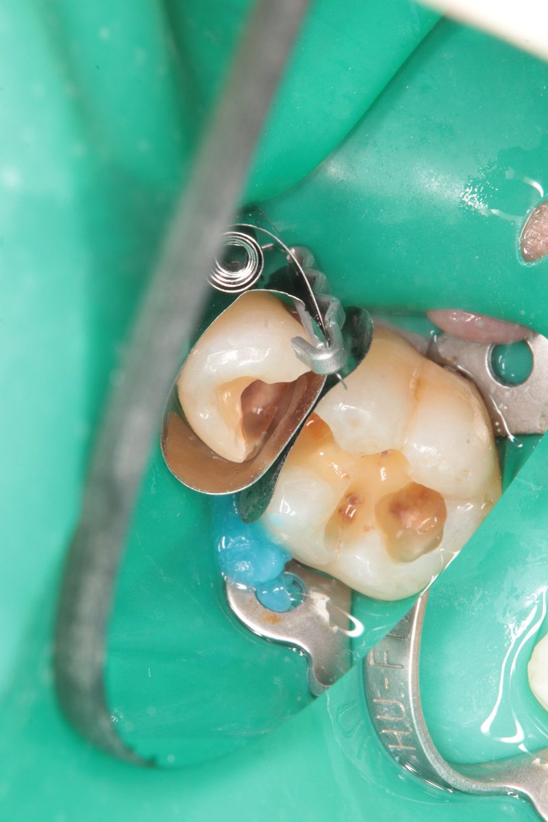 dentist_amar617's tweet image. حشوة قديمه سقطت من فترة  وتسوس عميق
تم ازالة التسوس القريب   من اللثة  وبناء حشوة
التسوس اثر على طرف السن  المجاور فلذلك تم ازالة التسوس وعمل حشوة له
#DME a d class II resto for lower 2nd premoalr and class II resto 1st molar back to back
Done with sno plow technique
#saveatooth