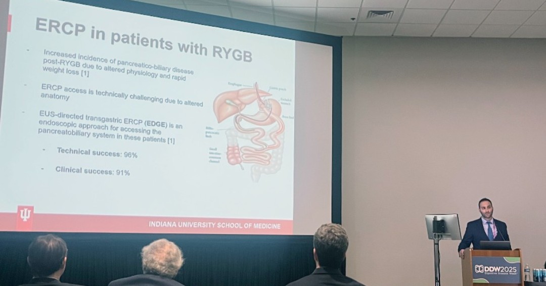 Indiana University Gastroenterology and Hepatology (@iugastro) on Twitter photo 🎉 Big congrats to <a href="/YIchkhanian/">Yervant Ichkhanian, MD</a> for his success at <a href="/DDWMeeting/">Digestive Disease Week</a>! 👏 We’re proud to see our fellows shaping the future of GI!
📌 "New Global Scheme for Post-Gastric #POEM Outcomes"
🎤 "Weight Regain & Fistula Recurrence After EDGE"
#GIFellowship #DDW2025 #GITwitter 🎉 Big congrats to <a href="/YIchkhanian/">Yervant Ichkhanian, MD</a> for his success at <a href="/DDWMeeting/">Digestive Disease Week</a>! 👏 We’re proud to see our fellows shaping the future of GI!
📌 "New Global Scheme for Post-Gastric #POEM Outcomes"
🎤 "Weight Regain & Fistula Recurrence After EDGE"
#GIFellowship #DDW2025 #GITwitter