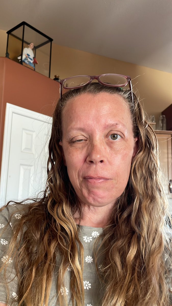 CarrieSak's tweet photo. 1419 days since I developed full Blume Bell’s palsy from my Covid vaccine. It was told to be 
“Safe &amp; Effective” 

1161 days since my team of doctors proved it to the government program and I was validated. I will never stop spreading awareness 🫶🏻 Can’t Stop Won’t Stop https://t.co/ji2ziObv8t