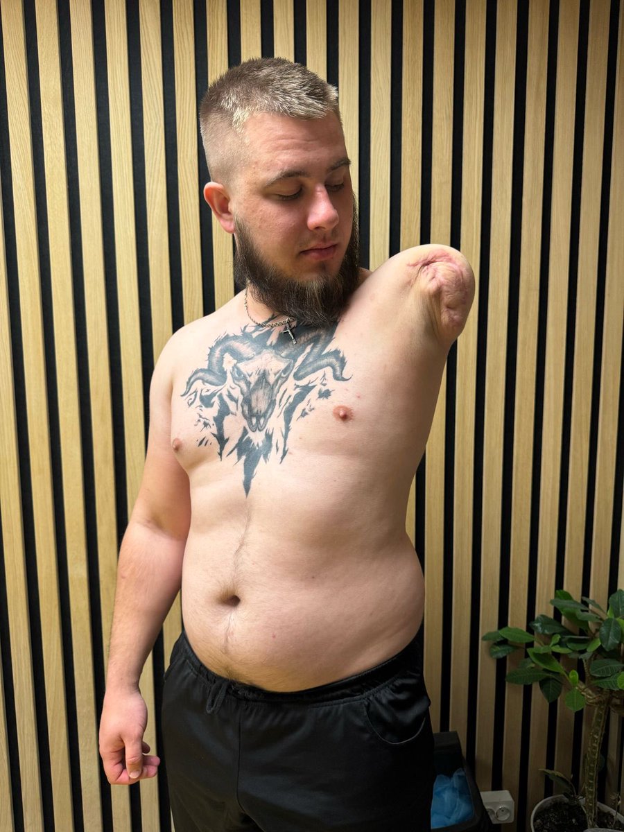 vlad_beseda's tweet image. ‼️Потрібен максимальний ретвіт‼️🙏

Денис Петлюк втратив руку захищаючи нас з вами. Хлопець мріє повернутись до повноцінного життя. 

Зараз потребує складної операції по вживленню імпланта в кістку.

Реквізити:
send.monobank.ua/jar/2EkggF4Q5Q

PayPal:
endoprotezcentr@gmail.com