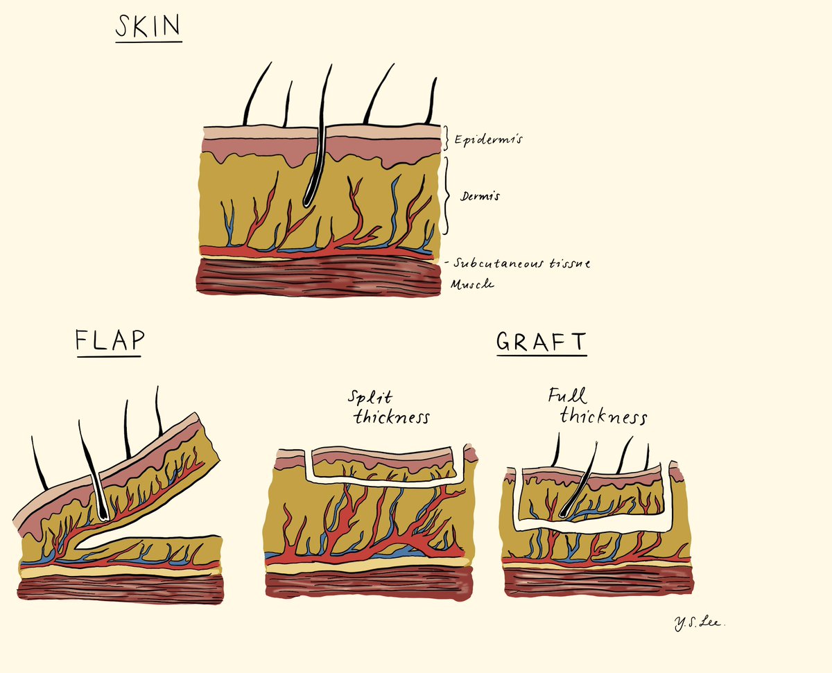 Yeonsoo Sara Lee, MD (@ysaralee) on Twitter photo Honored to have illustrated for the “Complex Flaps and Grafts in Urology” section in the <a href="/AmerUrological/">Amer. Urol. Assn.</a> Update Series 2025 working with <a href="/lee_c_zhao/">Lee Zhao</a> and <a href="/Uro_Jeff/">Jeffery Lin, MD 🏳️🌈</a> — both of whom I learned from during my away <a href="/NYUUrology/">NYU Langone Urology</a> last year. Time flies - thank you for including me! Honored to have illustrated for the “Complex Flaps and Grafts in Urology” section in the <a href="/AmerUrological/">Amer. Urol. Assn.</a> Update Series 2025 working with <a href="/lee_c_zhao/">Lee Zhao</a> and <a href="/Uro_Jeff/">Jeffery Lin, MD 🏳️🌈</a> — both of whom I learned from during my away <a href="/NYUUrology/">NYU Langone Urology</a> last year. Time flies - thank you for including me!
