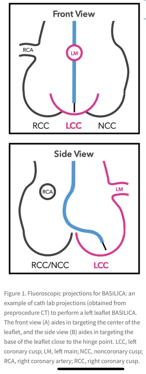 1/ Coronary artery obstruction during #TAVR is rare (~0.7%) but deadly.

Enter BASILICA:
Bioprosthetic or Native Aortic Scallop Intentional Laceration to Prevent Iatrogenic Coronary Artery obstruction.
A clever solution to a deadly problem.
#CardioTwitter #StructuralHeart