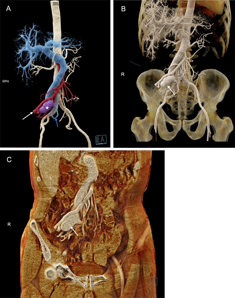 In this week's Images in Radiology, take a look at a CT cinematic rendering depicting superior mesenteric arteriovenous fistula. bit.ly/3Z4Nsf2