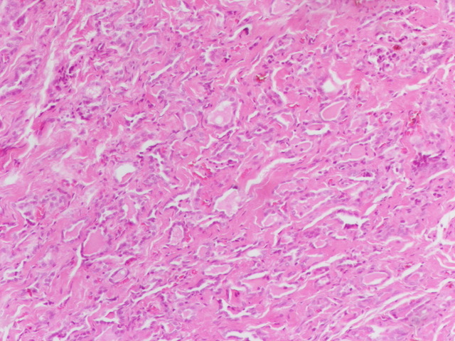 #ENTPath 
Young male ,mid line neck cystic  mass 
What do you think this  tissue is ?
And what will I show you in the next post tomorrow?