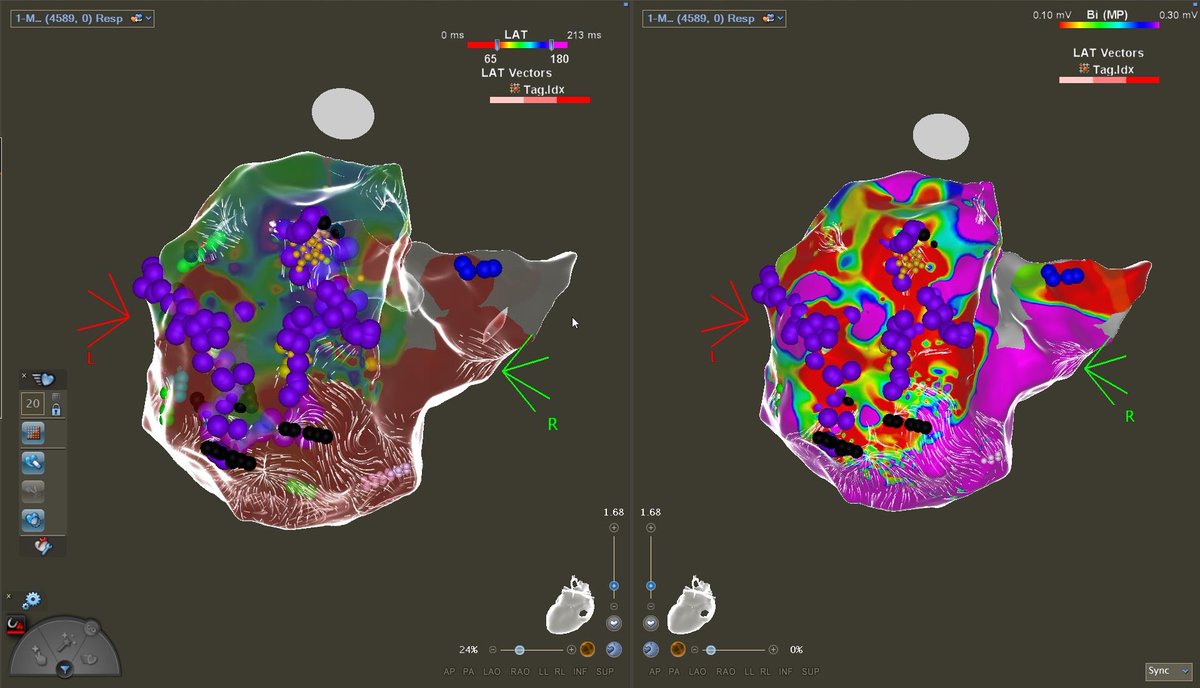 NNUH Cardiac Electrophysiology tweet media