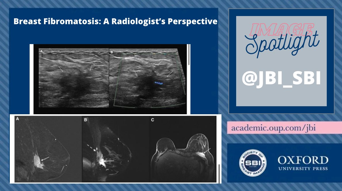 📢 LATEST #JBI IMAGE SPOTLIGHT📢

Fibromatosis: Rare condition,  locally limited to aggressive
Also k/as: desmoid tumor, aggressive fibromatosis 
Etiology: Unknown
Population: women, childbearing age after trauma/ surgical procedure

Read more 👇🏻👇🏻👇🏻

doi.org/10.1093/jbi/wb…