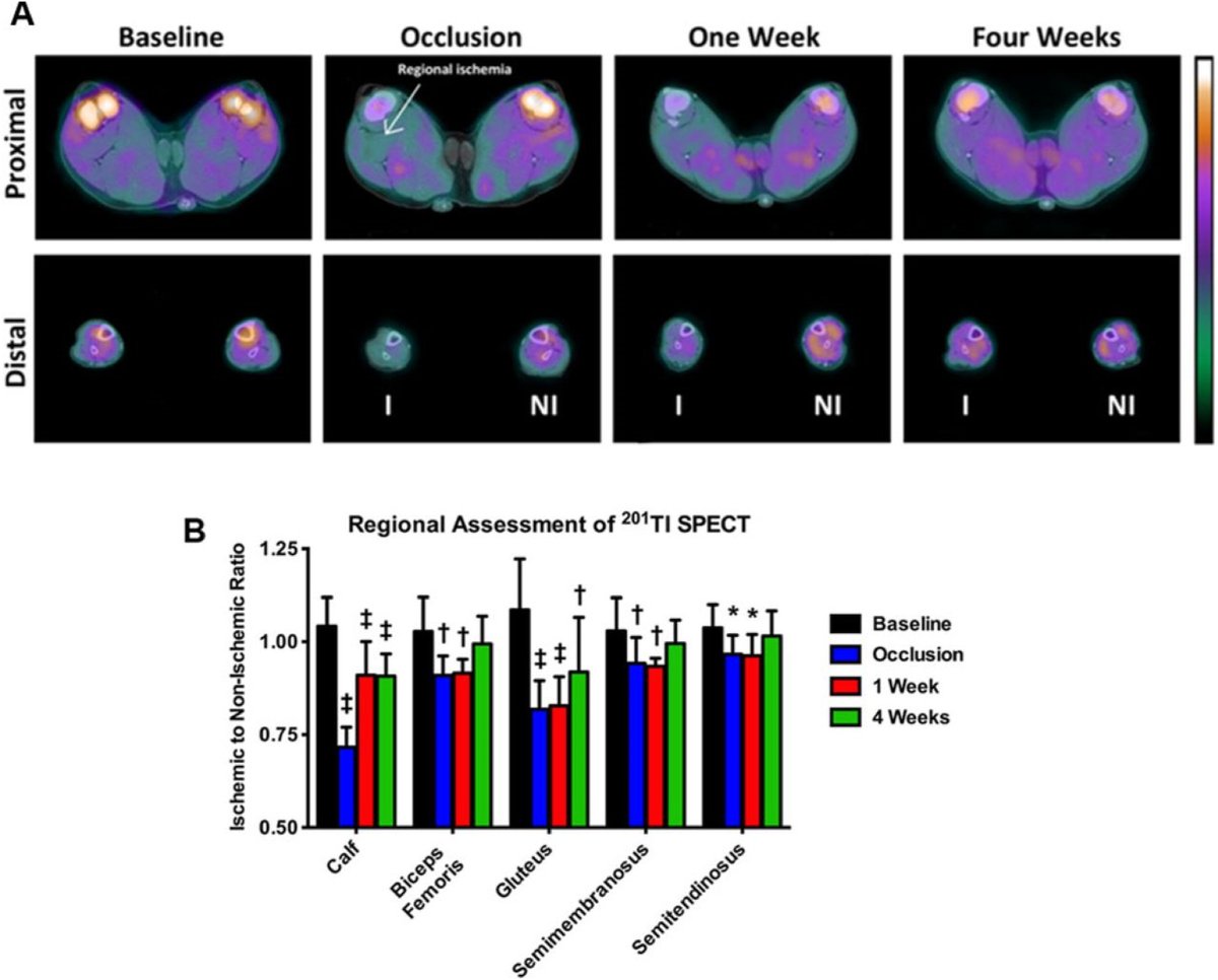 Journal of Nuclear Cardiology (@jncjournal) on Twitter photo Exploring new horizons in nuclear cardiology – assessing perfusion, physiology and the microcirculation in peripheral arterial disease. A State-of-the-Art Review by <a href="/sacalle1/">Santiago Callegari</a> and Dr. Al Sinusas, <a href="/YaleCardiology/">Yale Cardiology</a> #cvnuc #PAD #VascularImaging
Read now👉bit.ly/43erhVg Exploring new horizons in nuclear cardiology – assessing perfusion, physiology and the microcirculation in peripheral arterial disease. A State-of-the-Art Review by <a href="/sacalle1/">Santiago Callegari</a> and Dr. Al Sinusas, <a href="/YaleCardiology/">Yale Cardiology</a> #cvnuc #PAD #VascularImaging
Read now👉bit.ly/43erhVg