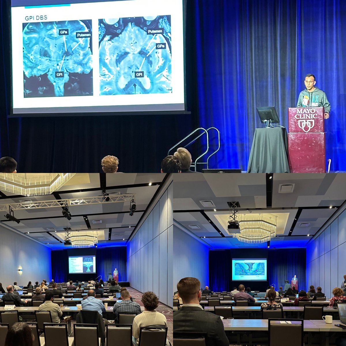 JamieVanGompel's tweet image. Kicking off the 2025 @MayoClinic @MayoClinicNeuro Neuro stimulation course with @Dr_JP_Parker and @SeizureSurgeon with a bang!  Looking forward to the next several days deep diving #EpilepsyAwareness #Rochester