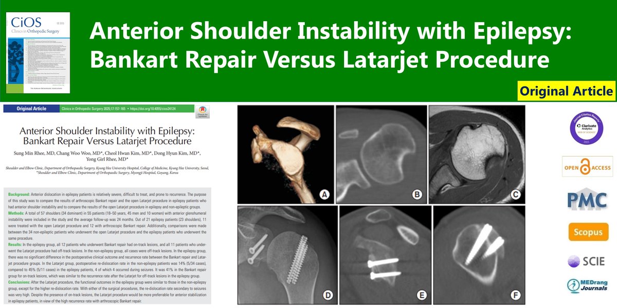 Anterior Shoulder Instability with Epilepsy: Bankart Repair Versus Latarjet Procedure
🌷doi.org/10.4055/cios24…
Clin Orthop Surg. 2025 Feb;17(1)Sung Min Rhee
#Epilepsy #Latarjet #Bankart #Joint_instability #Shoulder_dislocation