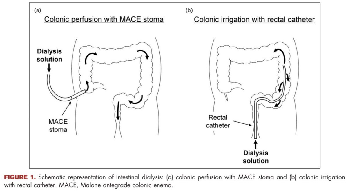 Your Gut may be the next dialysis machine

#CKD =Gut dysbiosis ⚠️→ Uremic Toxins☠️→ CVD❤️‍🔥 &amp; CKD🫘progression

Can intestinal dialysis, 💊 oral adsorbents &amp; 🧫microbiota modulation help?

🔗 doi.org/10.1097/MNH.00… 

#NephTwitter #Uremia #Microbiome #Nephrology #GutKidneyAxis