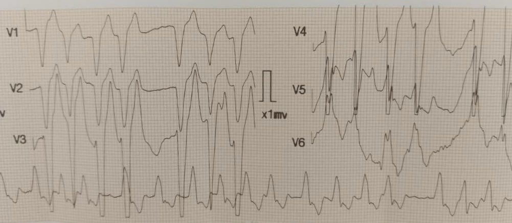 Carlos M. Peñate, MD (@carlos_penate6) on Twitter photo Without context, my friend sent it to me.
<a href="/ecgandrhythmRoe/">Andreas Roeschl, MD</a>
<a href="/ecgrhythms/">Arnel Carmona</a>
<a href="/JL_MoralesArt/">José Luis Morales</a> Without context, my friend sent it to me.
<a href="/ecgandrhythmRoe/">Andreas Roeschl, MD</a>
<a href="/ecgrhythms/">Arnel Carmona</a>
<a href="/JL_MoralesArt/">José Luis Morales</a>