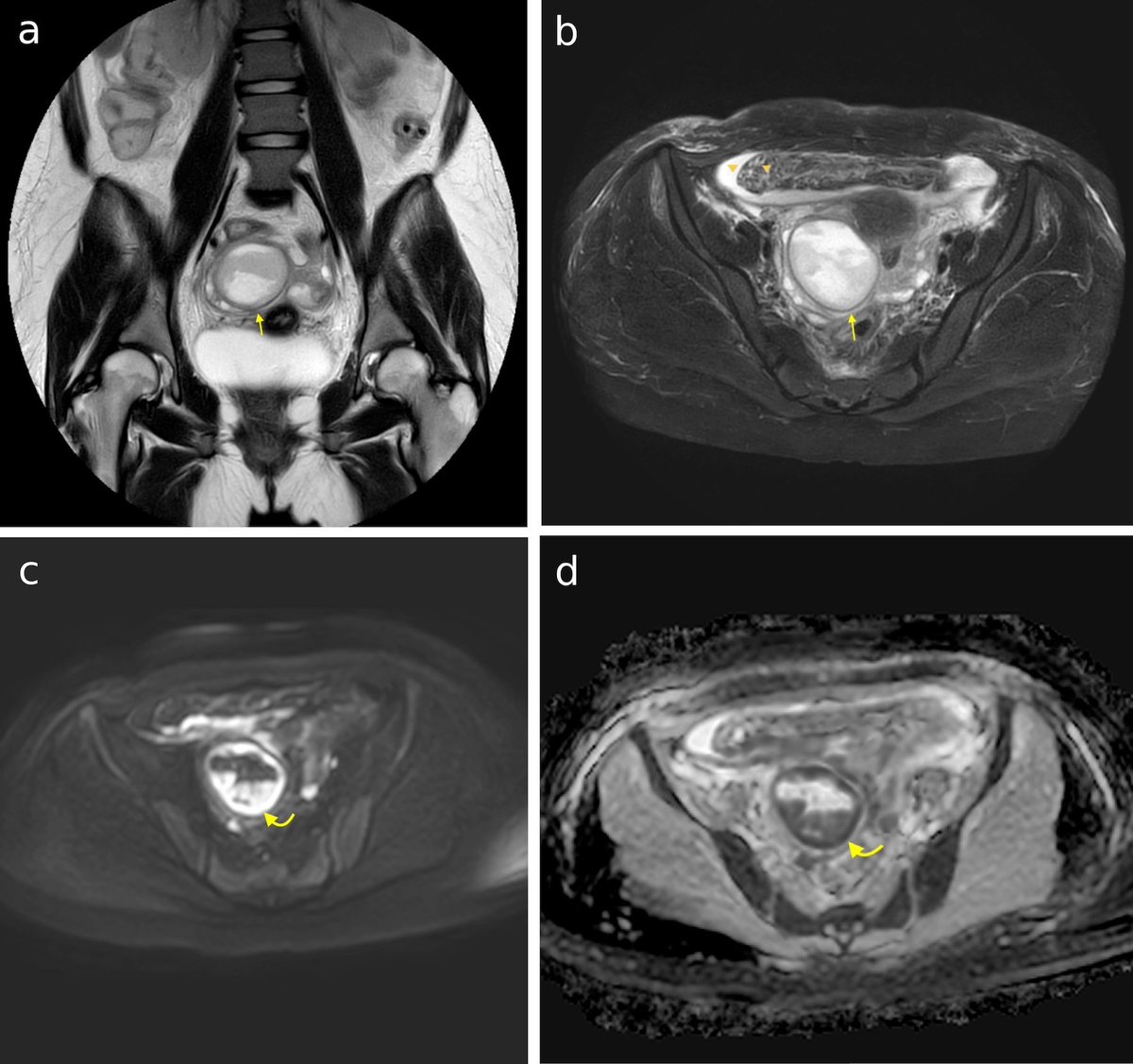 Sharing a nice article published in  "Journal of Clinical #Gynecology &amp; #Obstetrics":  A Tubo-Ovarian Abscess Caused by #Salmonella enterica  jcgo.elmerpub.com/index.php/jcgo…