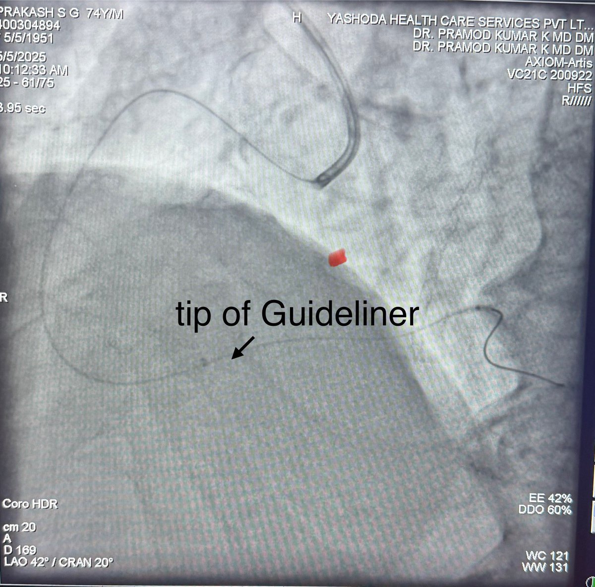 praheart's tweet photo. AL + #Guideliner = power house support for distal PLVB/PDA PCI.
Alternatively 3DRC/JR can be “Amplatzed” with clockwise torque + gentle forward push, but don’t match AL’s backup.
Here’s a critical #PLVB cracked successfully. #ComplexPCI #InterventionalCardiology @teleflex https://t.co/T9ZRrI6V14