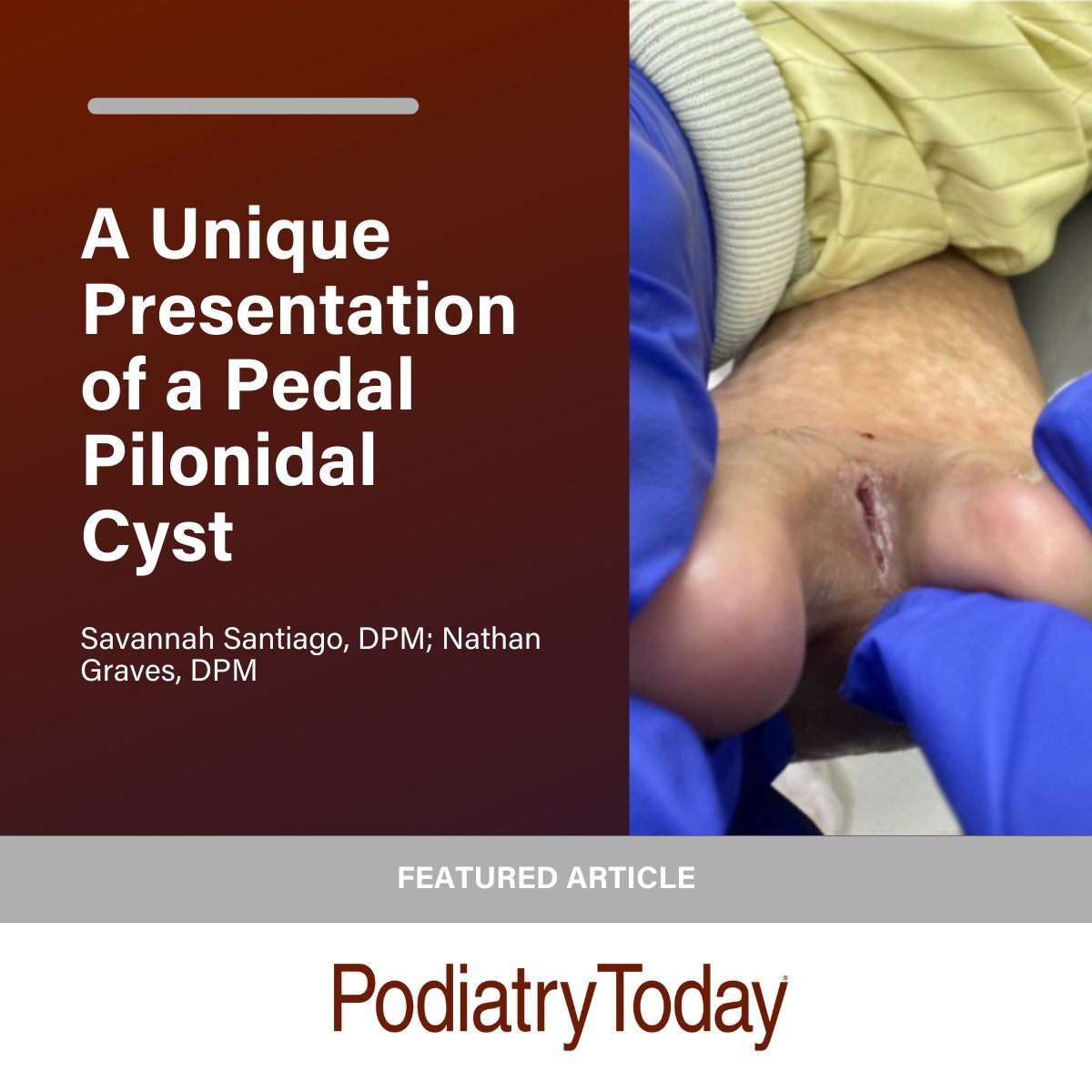 PodiatryToday's tweet image. This latest case study highlights a novel presentation of a known condition. Read more at: tinyurl.com/h7hf9n57