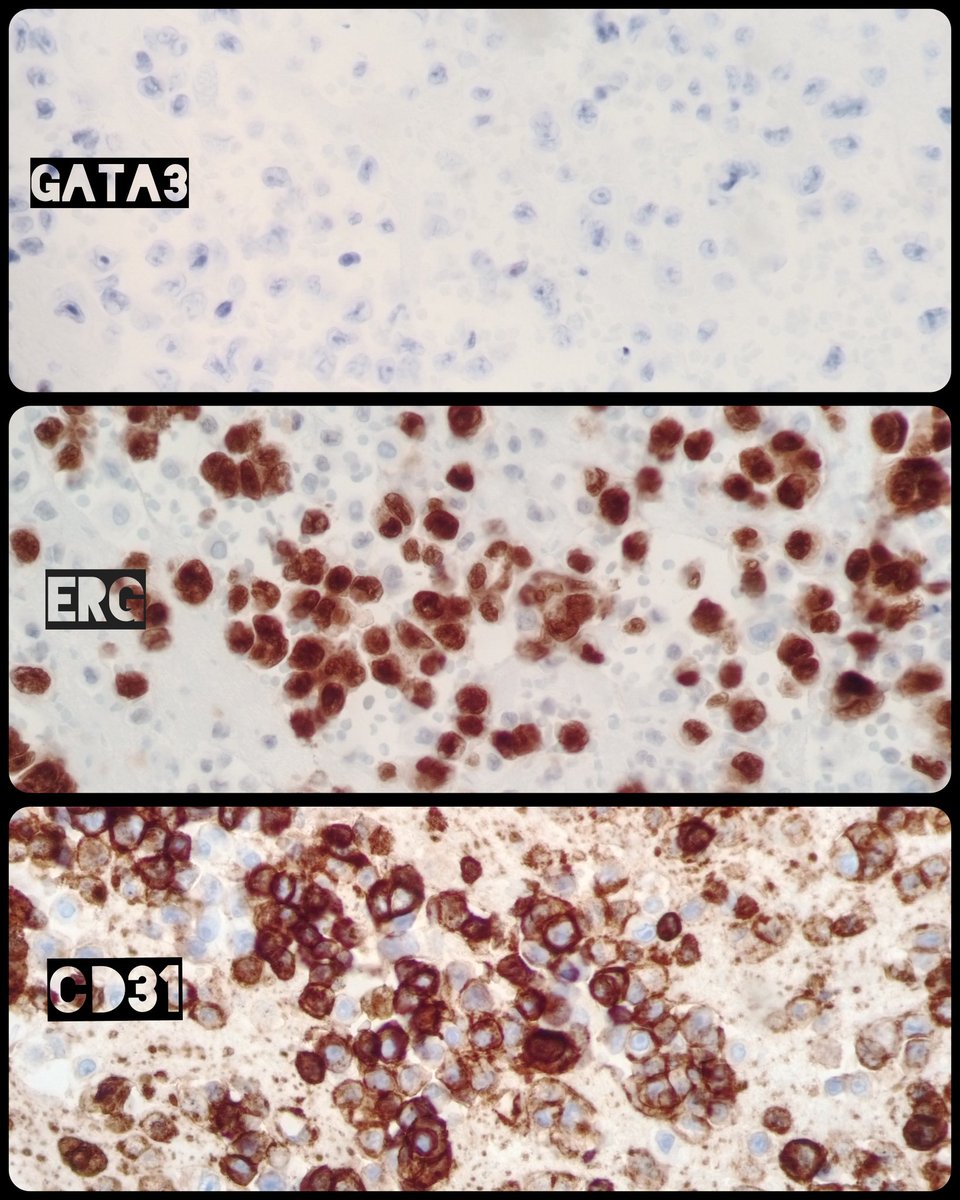 🏥 Medical record: Breast cancer ➕ Post-radiation Angiosarcoma.
🫁 Pleural effusion 💉.
🔬 Metastatic Angiosarcoma.  Category 5️⃣ The International System for Reporting Serous Fluid Cytopathology.

#Cytology #CytoPath #PathX