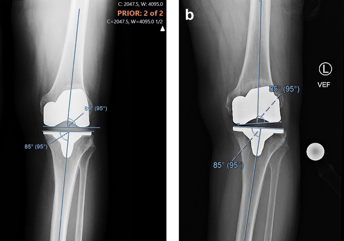 CASE REPORT: Lateral Instability 13 Years After Kinematically Aligned Total Knee Arthroplasty

This article suggests that excessive varus alignment should be avoided when using kinematic alignment in TKA.

<a href="/boettner/">Friedrich Boettner</a> <a href="/HSpecialSurgery/">Hospital for Special Surgery (HSS)</a> <a href="/kevin_ilo/">kevin ilo</a>

arthroplastytoday.org/article/S2352-…