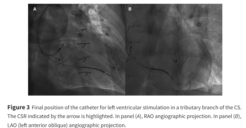European Society of Cardiology Journals (@esc_journals) on Twitter photo Is there room for CRT in patients with coronary sinus reducer devices? ow.ly/ZazN50VSn7N
#EHJCaseReports <a href="/Phiso_de/">Philipp Sommer</a> <a href="/TJ_Yeo/">Tee Joo YEO</a> <a href="/aayshacader/">Aaysha Cader</a> <a href="/BoldiKovacsMD/">Boldizsar Kovacs</a> <a href="/KardiologieHH/">Erik Rafflenbeul</a> <a href="/ANazmiCalik/">A.Nazmi Calik</a> <a href="/O_Azizy_MD/">Obayda Azizy</a> <a href="/saramoscatelli7/">Sara Moscatelli</a> <a href="/EHJCREiC/">EHJCaseReports Editor-in-Chief</a> #CardioX #EPeeps Is there room for CRT in patients with coronary sinus reducer devices? ow.ly/ZazN50VSn7N
#EHJCaseReports <a href="/Phiso_de/">Philipp Sommer</a> <a href="/TJ_Yeo/">Tee Joo YEO</a> <a href="/aayshacader/">Aaysha Cader</a> <a href="/BoldiKovacsMD/">Boldizsar Kovacs</a> <a href="/KardiologieHH/">Erik Rafflenbeul</a> <a href="/ANazmiCalik/">A.Nazmi Calik</a> <a href="/O_Azizy_MD/">Obayda Azizy</a> <a href="/saramoscatelli7/">Sara Moscatelli</a> <a href="/EHJCREiC/">EHJCaseReports Editor-in-Chief</a> #CardioX #EPeeps
