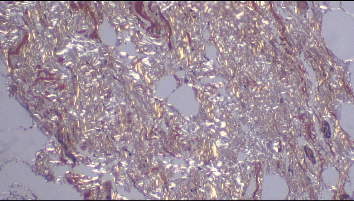 Some doctors ask me if they should send all kinds of specimens for pathological analysis.

This case is a good answer: systemic #amyloidosis diagnosed through an inguinal hernia specimen 😱😱

HE, Congo red, apple-green birefringence

#pathology #patologia #patología #path