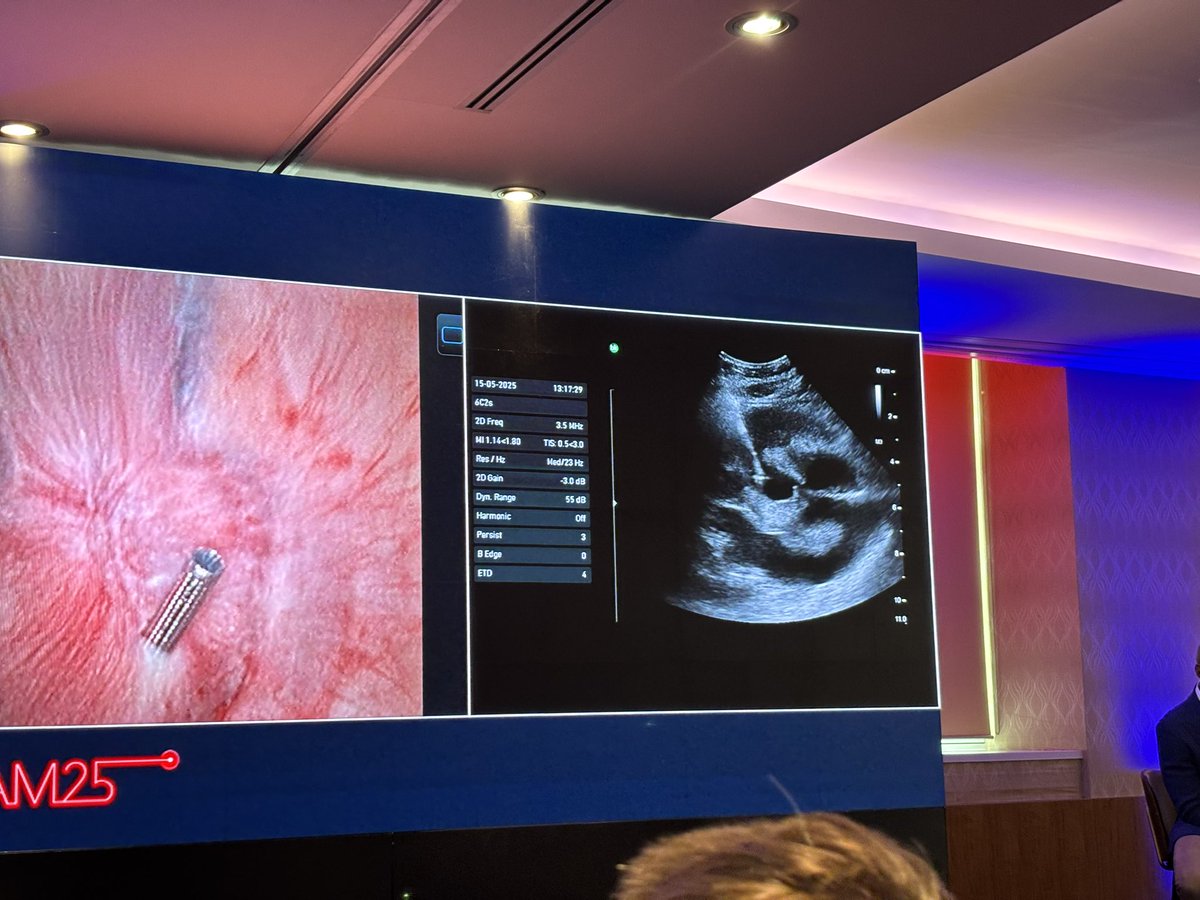 Amelia Pietropaolo (@ameliapietr1) on Twitter photo #BEAM25 has started with engaging debates and heated discussions.
Now don’t miss the outstanding didactic ECIRS performed by <a href="/thomastailly/">Thomas Tailly</a> <a href="/thomaschi8/">Thomas Chi</a> using <a href="/ambu/">ambu</a> ureteroscope 🔭 and Clear Petra <a href="/JustineShi_js/">@ClearPetra-Well Lead</a> 🪠
You are still on time to register 📌 beam25.be/register #BEAM25 has started with engaging debates and heated discussions.
Now don’t miss the outstanding didactic ECIRS performed by <a href="/thomastailly/">Thomas Tailly</a> <a href="/thomaschi8/">Thomas Chi</a> using <a href="/ambu/">ambu</a> ureteroscope 🔭 and Clear Petra <a href="/JustineShi_js/">@ClearPetra-Well Lead</a> 🪠
You are still on time to register 📌 beam25.be/register
