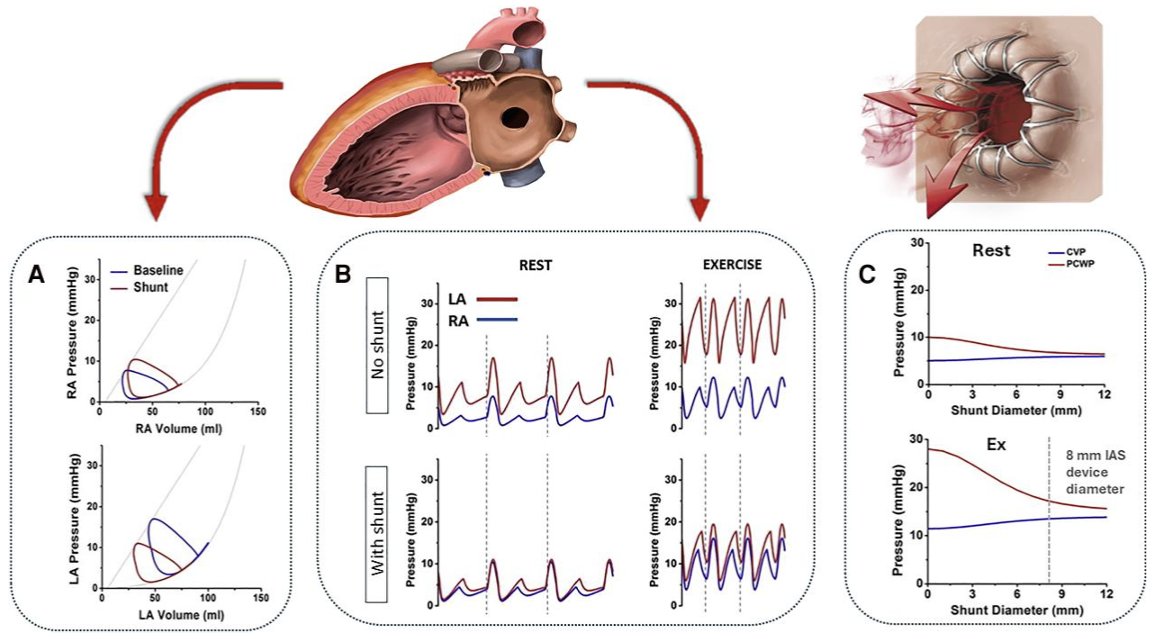 GreggWStone's tweet image. Our publ in EHJ: state of the art review of intrer-atrial shunting - potentially a major breakthrough in HFrEF and selected pts with HFpEF. Add to this the ongoing placebo-procedure controlled ALLAY-HFrEF trial which has just started randomizing 350 HFrEF pts.