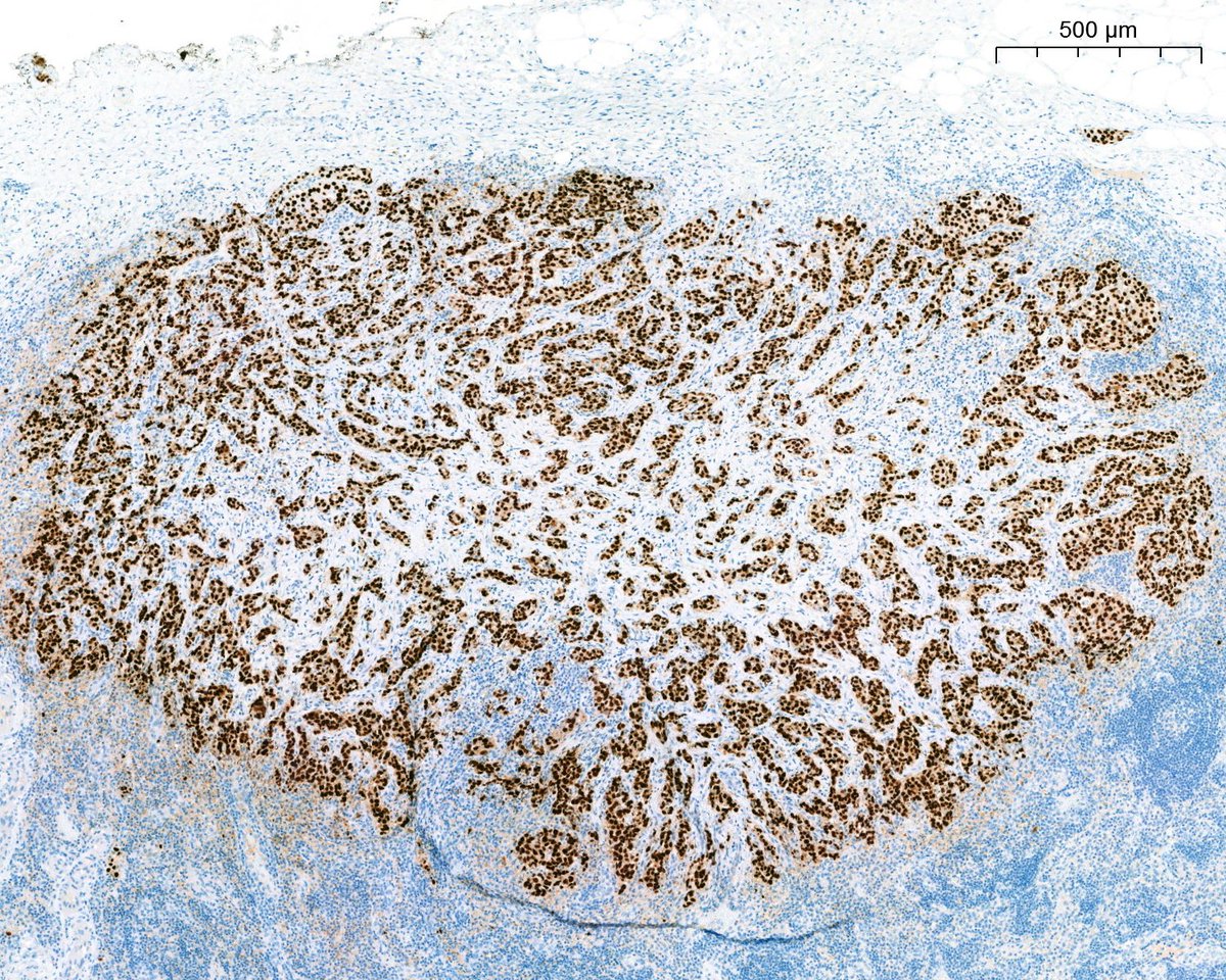 A. Polónia (@poloniaantonio) on Twitter photo Have you ever seen such a case?🤯No tumor in the gallbladder...where is this coming from? <a href="/atman_ci/">Dr. Luca</a> <a href="/DrGeeONE/">Olaleke Folaranmi</a> <a href="/fouad_boulos/">Fouad Boulos</a> <a href="/RazaHoda/">Raza Hoda MD</a> <a href="/ADamronMD/">Alexander Damron, MD</a> <a href="/Teclis82/">Brian McMillen MD</a> <a href="/LizaMQuintana/">Liza Quintana, MD</a> <a href="/tlabiano/">Tania Labiano</a>
<a href="/A_Morini_MD/">Aurélien Morini, MD, MSc 🇫🇷🇪🇺💙💛</a> <a href="/ariella8/">Celina Stayerman MD</a> <a href="/surgpathlahore/">Nusrat Z. Bokhari</a> <a href="/amalasar86/">Amal Asar, FRCPath, MAcadMED</a> <a href="/TristanRutland7/">Tristan Rutland MBBS FRCPA IFCAP</a> <a href="/israhkhan/">Israh Akhtar Khan</a> <a href="/kis_lorand/">Lorand Kis</a> Have you ever seen such a case?🤯No tumor in the gallbladder...where is this coming from? <a href="/atman_ci/">Dr. Luca</a> <a href="/DrGeeONE/">Olaleke Folaranmi</a> <a href="/fouad_boulos/">Fouad Boulos</a> <a href="/RazaHoda/">Raza Hoda MD</a> <a href="/ADamronMD/">Alexander Damron, MD</a> <a href="/Teclis82/">Brian McMillen MD</a> <a href="/LizaMQuintana/">Liza Quintana, MD</a> <a href="/tlabiano/">Tania Labiano</a>
<a href="/A_Morini_MD/">Aurélien Morini, MD, MSc 🇫🇷🇪🇺💙💛</a> <a href="/ariella8/">Celina Stayerman MD</a> <a href="/surgpathlahore/">Nusrat Z. Bokhari</a> <a href="/amalasar86/">Amal Asar, FRCPath, MAcadMED</a> <a href="/TristanRutland7/">Tristan Rutland MBBS FRCPA IFCAP</a> <a href="/israhkhan/">Israh Akhtar Khan</a> <a href="/kis_lorand/">Lorand Kis</a>