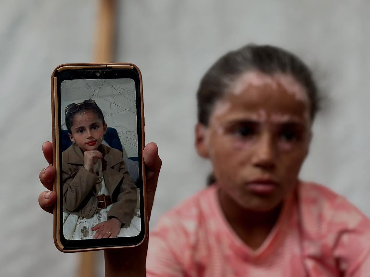Lana Al Sharif, 10 years old, displaced from Rafah to Khan Yunis, developed a skin disease as a result of fear of the occupation bombing a house next to theirs. Lana suffers from bullying by her friends because of the gray hair in her hair, "You are old." She wishes to travel